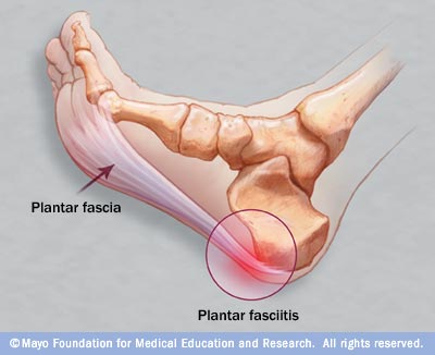 plantarfascia